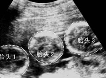 试管婴儿怎么做的全过程？让试管婴儿成功率更高的方式有哪些？